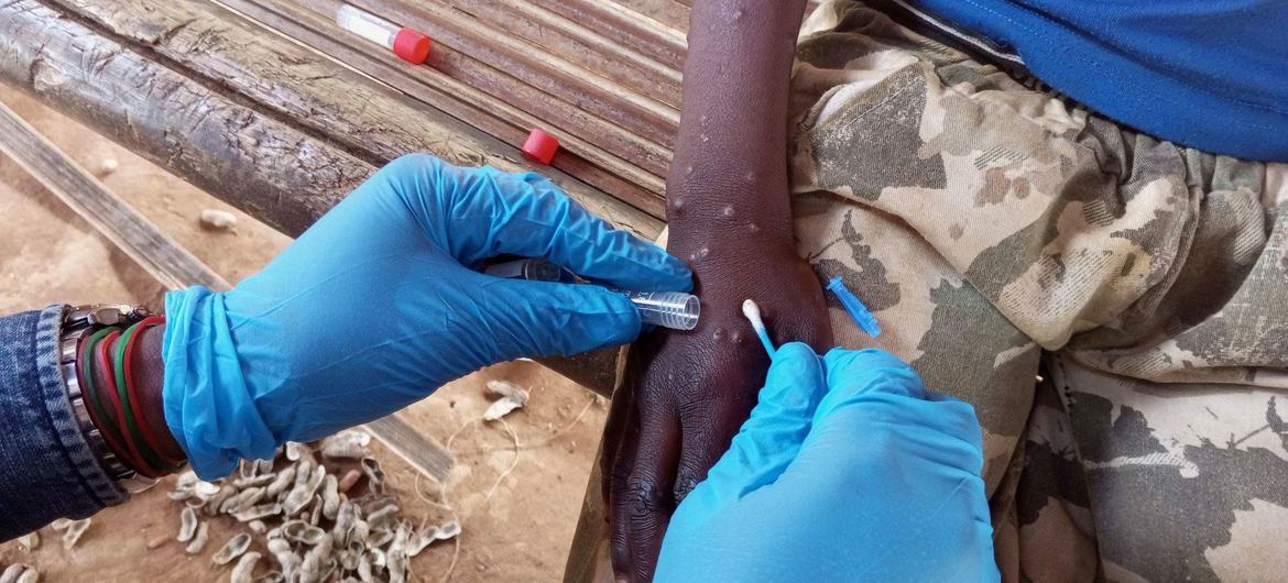 Un centre de traitement de Mpox